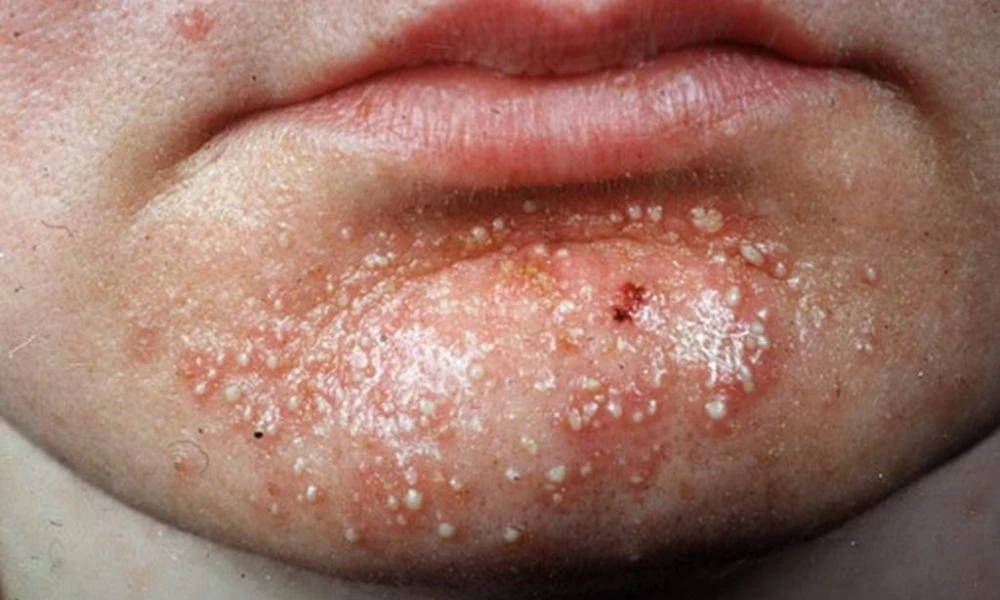 Ποιοι είναι οι συχνότεροι τρόποι μετάδοσης του σταφυλόκοκκου